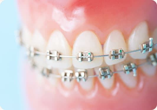 多くの患者さまの歯並びを矯正してきたスタンダードな矯正装置