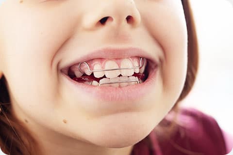 6~12歳頃からの矯正治療<